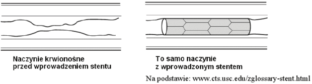 Angioplastyka